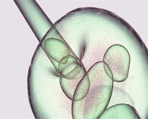 多囊卵巢综合征的症状表现与助孕调理指南